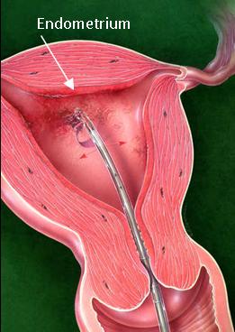 Endometrium